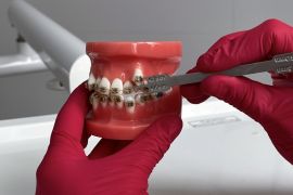 Установка брекет - системы